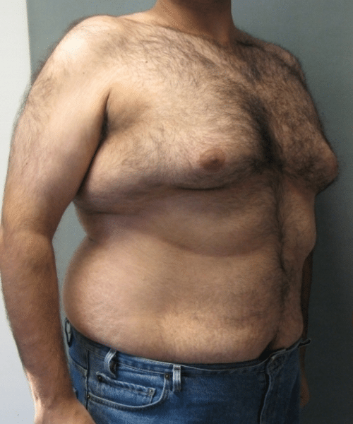 Pseudogynecomastia