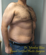 Pseudogynecomastia