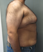 Pseudogynecomastia