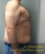 Pseudogynecomastia