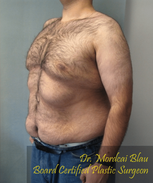 Pseudogynecomastia