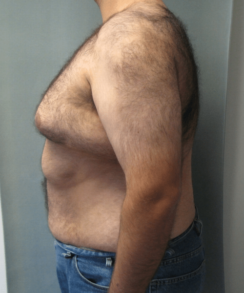 Pseudogynecomastia