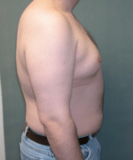 Pseudogynecomastia