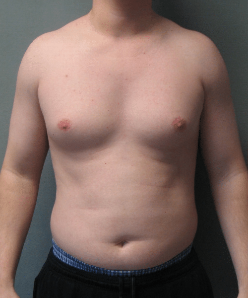 Pseudogynecomastia Before Photo Pseudogynecomastia