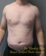 Pseudogynecomastia