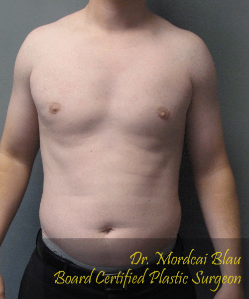 Pseudogynecomastia After Photo Pseudogynecomastia