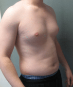 Pseudogynecomastia