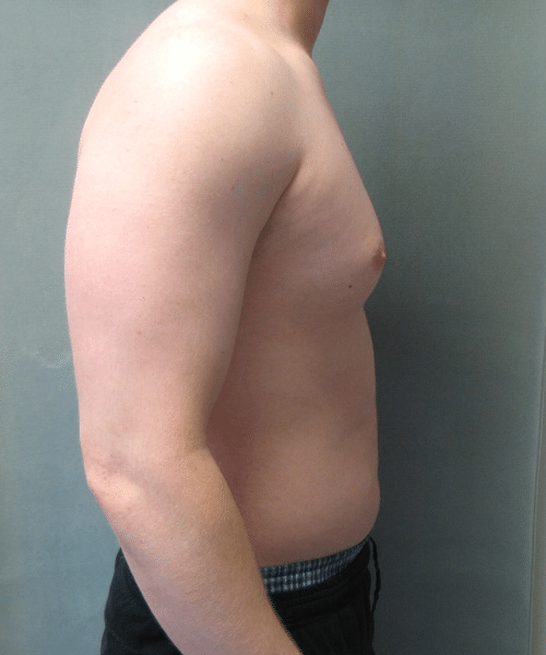 Pseudogynecomastia