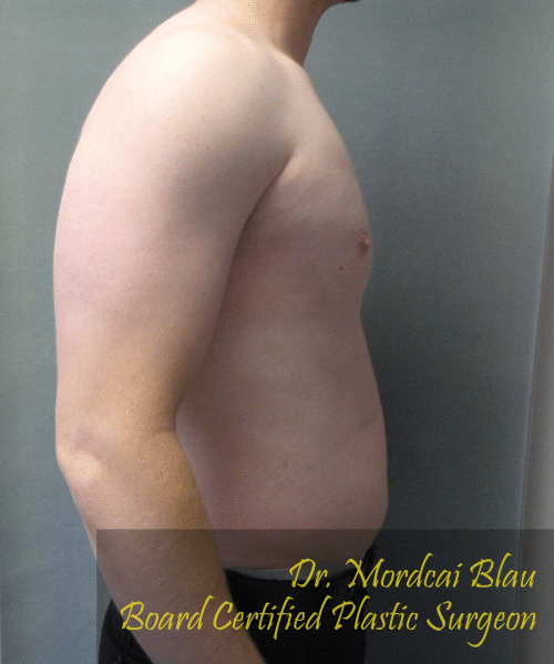 Pseudogynecomastia