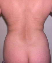 back and waist liposuction
