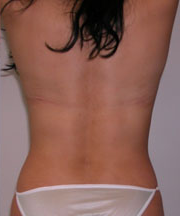 back rolls liposuction
