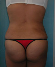 Back & Waist After Photo Back & Waist
