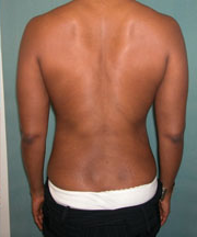 Back & Waist After Photo Back & Waist