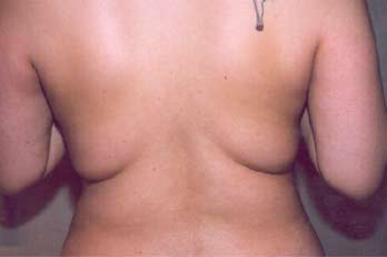 Back & Waist Before Photo Back & Waist