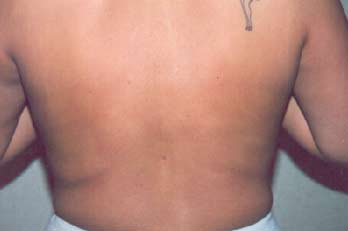 Back & Waist After Photo Back & Waist