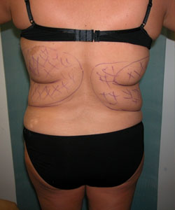 Back & Waist Before Photo Back & Waist