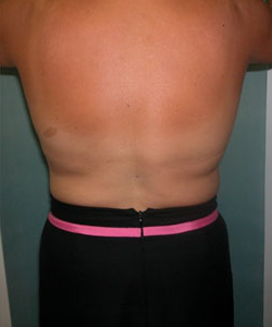 Back & Waist After Photo Back & Waist