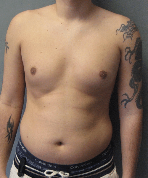 Pseudogynecomastia Before Photo Pseudogynecomastia