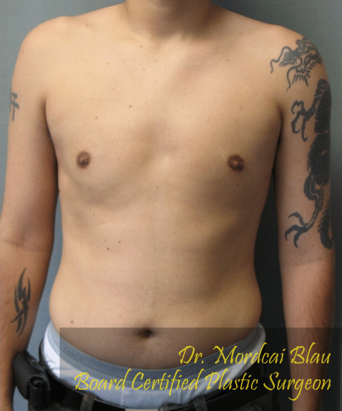 Pseudogynecomastia After Photo Pseudogynecomastia