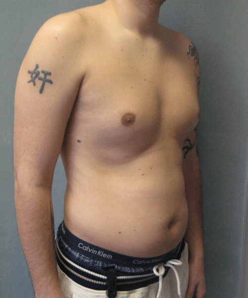 Pseudogynecomastia