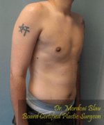 Pseudogynecomastia