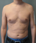 Pseudogynecomastia