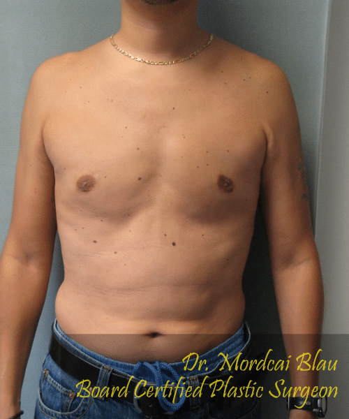 Pseudogynecomastia After Photo Pseudogynecomastia