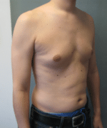 Pseudogynecomastia