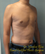 Pseudogynecomastia