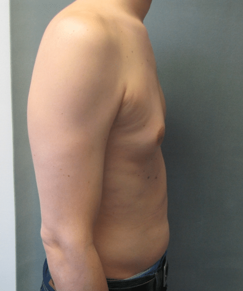 Pseudogynecomastia