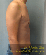 Pseudogynecomastia