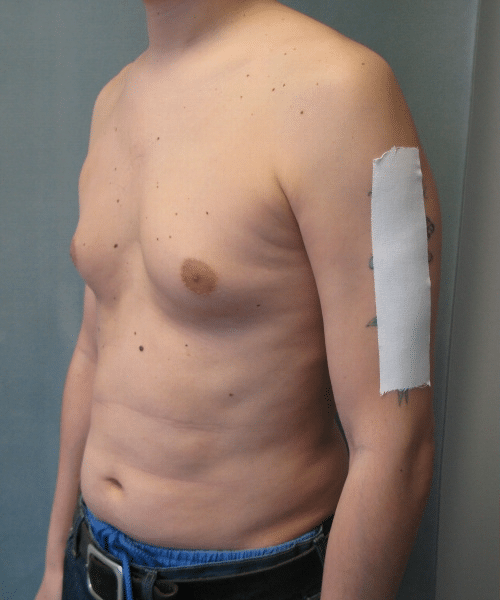 Pseudogynecomastia