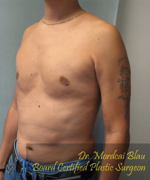 Pseudogynecomastia