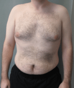 Pseudogynecomastia