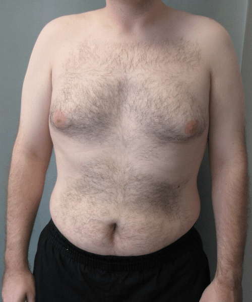 Pseudogynecomastia Before Photo Pseudogynecomastia