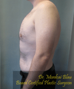 Pseudogynecomastia