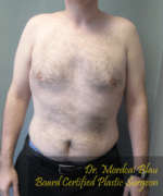 Pseudogynecomastia