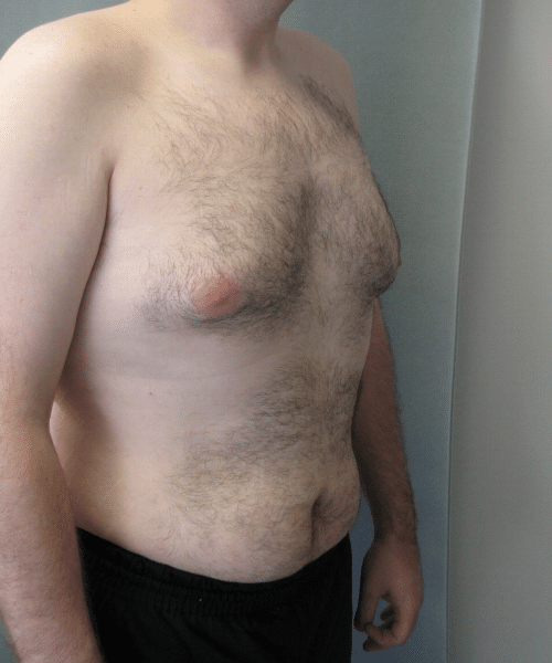 Pseudogynecomastia