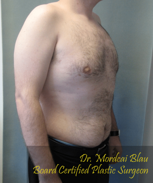 Pseudogynecomastia