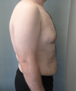 Pseudogynecomastia