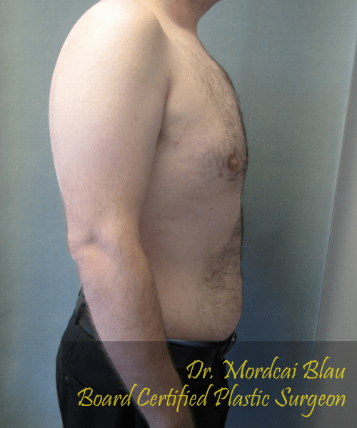 Pseudogynecomastia