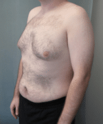 Pseudogynecomastia