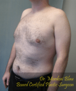 Pseudogynecomastia