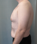 Pseudogynecomastia