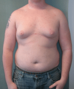 Pseudogynecomastia