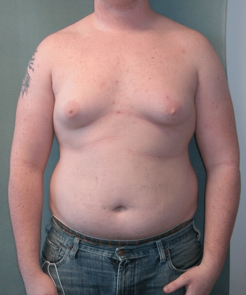 Pseudogynecomastia Before Photo Pseudogynecomastia