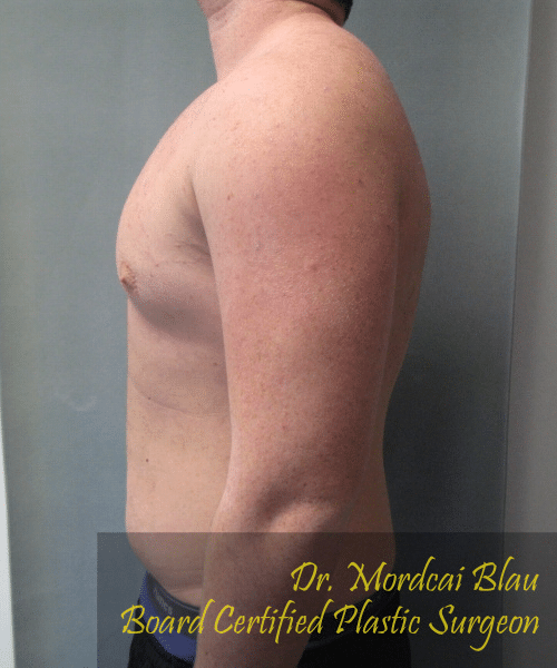 Pseudogynecomastia