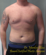 Pseudogynecomastia