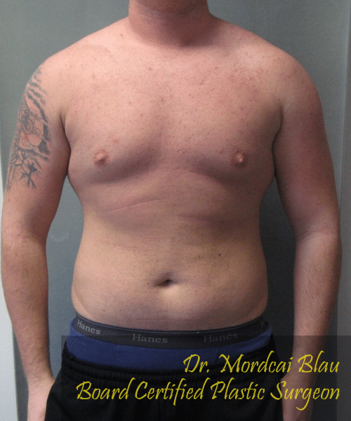 Pseudogynecomastia After Photo Pseudogynecomastia