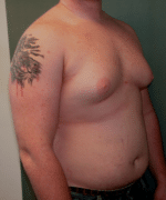 Pseudogynecomastia